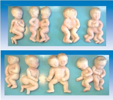胎儿畸形模型